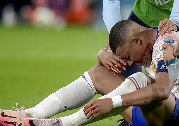 Euro 2024: Κάταγμα στην μύτη ο Μπαπέ – Θα παίζει με προστατευτική μάσκα
