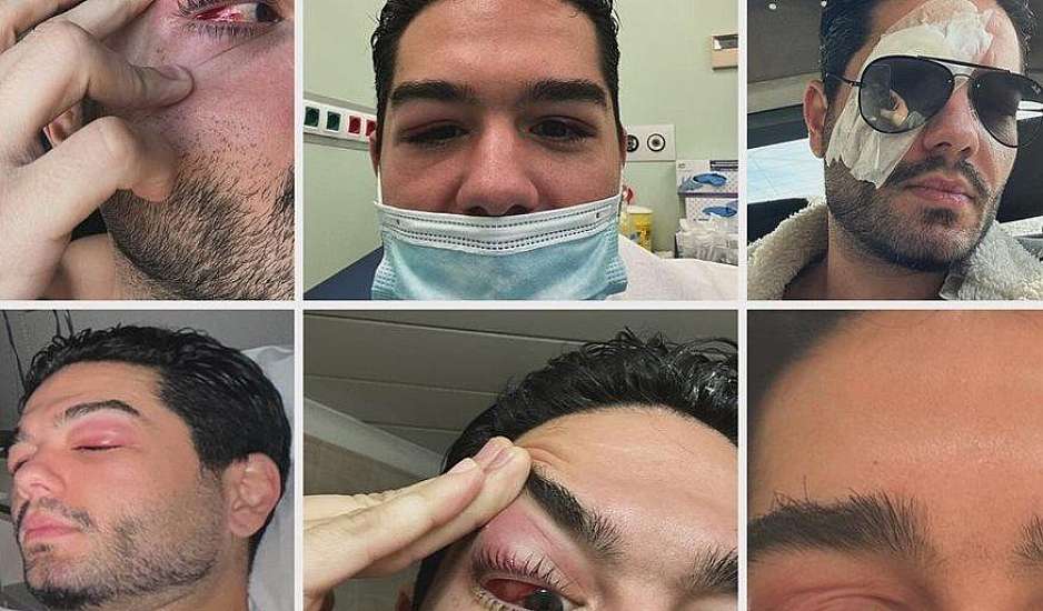 Χρήστος Μάστορας: Σοκάρουν οι φωτογραφίες του προσώπου του μέσα από το νοσοκομείο