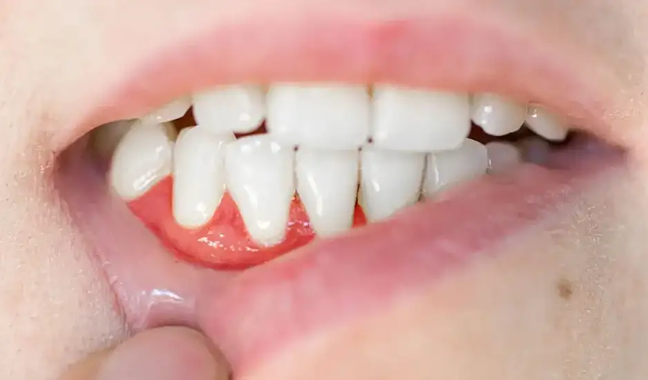 Γιατί πρέπει να φροντίζετε τα δόντια σας αν θέλετε γερή καρδιά
