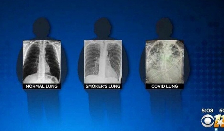 Έτσι είναι οι πνεύμονες ενός ασθενή με κορονοϊό, ενός καπνιστή και ενός υγιούς ανθρώπου