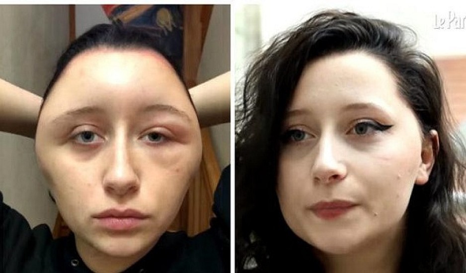 Έπαθε αλλεργία από βαφή μαλλιών - Το κεφάλι της διογκώθηκε στο διπλάσιο