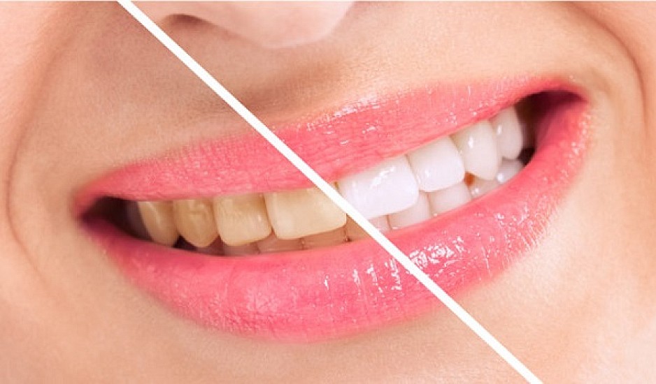 Πώς να αποκτήσετε ολόλευκα δόντια με φυσικό τρόπο