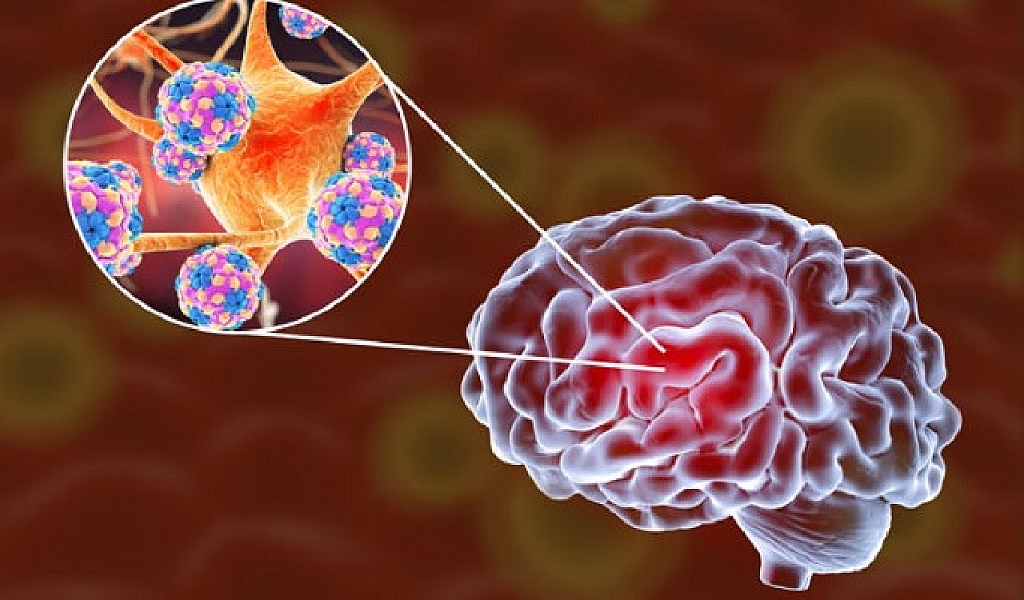 Εγκεφαλίτιδα: Η «ύπουλη» φλεγμονή του εγκεφάλου - Ποια τα πρώτα συμπτώματα