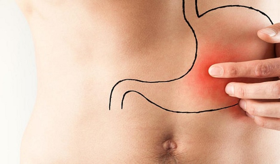 Έλκος στομάχου: Τι είναι ακριβώς, από τι προκαλείται και πώς αντιμετωπίζεται