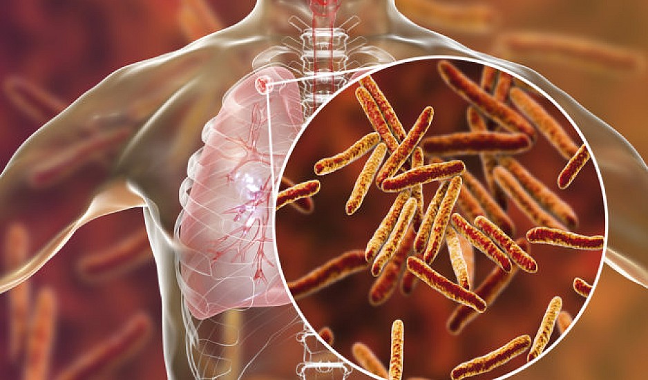 Τι πρέπει να ξέρετε για την φυματίωση: Συμπτώματα, πώς κολλάει και τι θεραπεία έχει