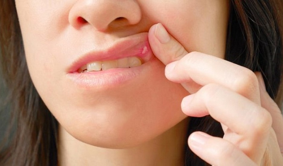 Τι να κάνετε για τις άφθες στο στόμα