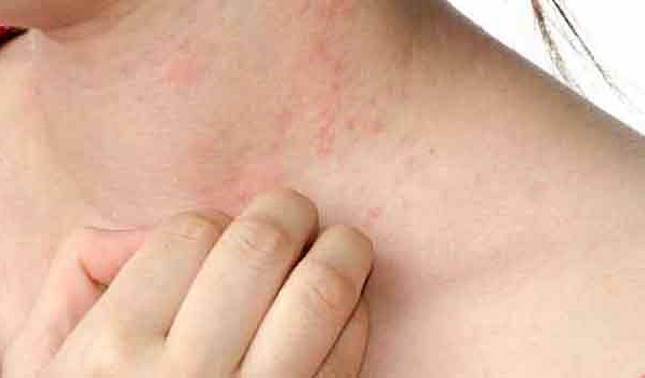 Τροφικές αλλεργίες: Τα συμπτώματα που πρέπει να γνωρίζετε