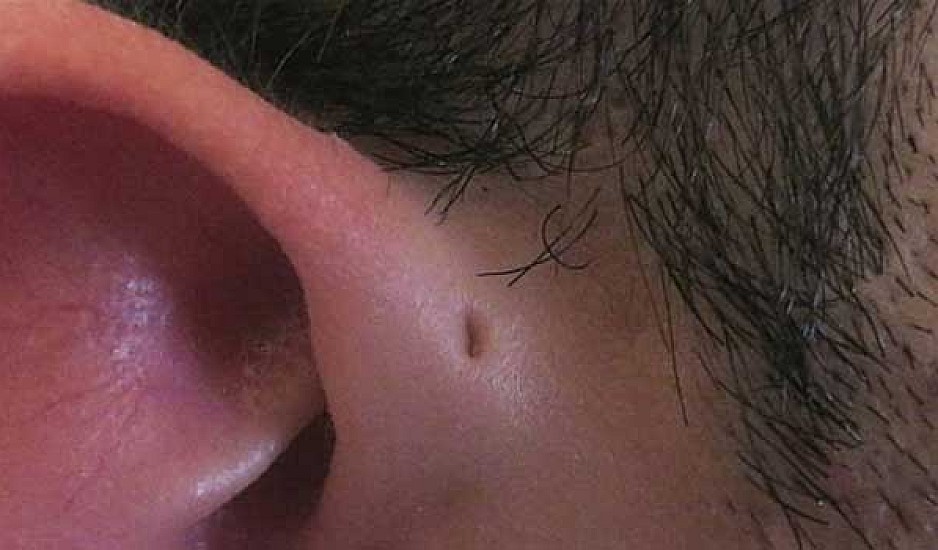 Αν έχετε αυτές τις μικρές τρυπίτσες γύρω από τα αυτιά μην ανησυχείτε
