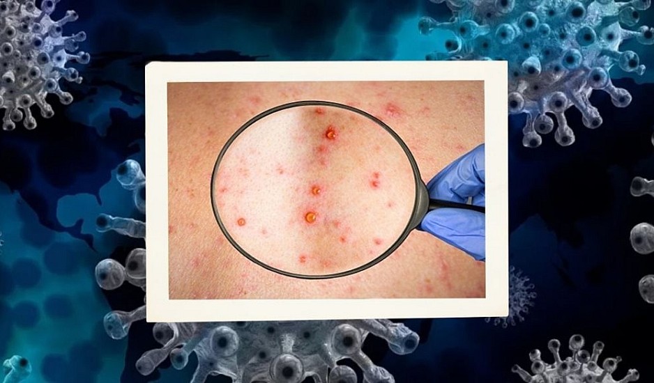 Eυλογιά των πιθήκων: Δεν υπάρχουν αποδείξεις ότι ο ιός έχει μεταλλαχθεί - Τι να κάνετε σε περίπτωση μόλυνσης