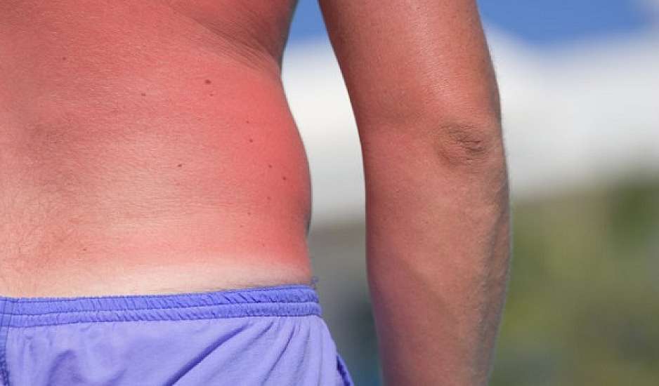 Έγκαυμα από τον ήλιο: Τι πρέπει να κάνεις