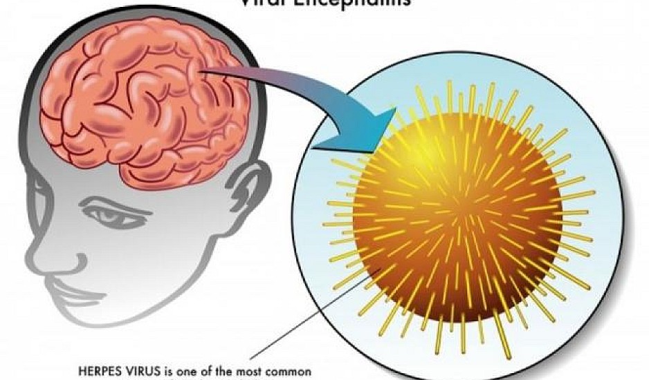 Εγκεφαλίτιδα: Από τι προκαλείται και πώς αντιμετωπίζεται