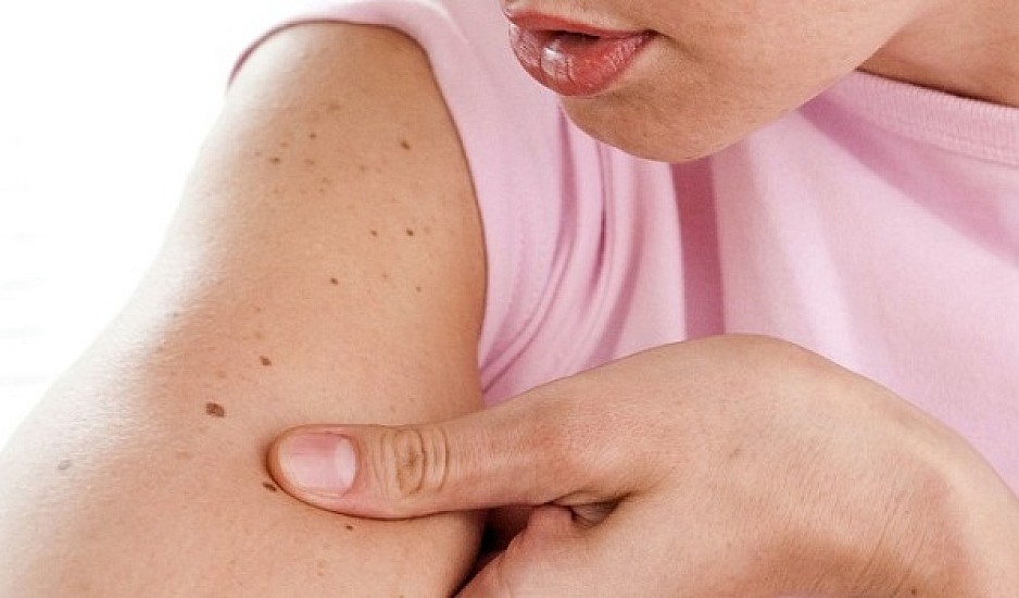 Ελιές στο δέρμα: Τα σημάδια που δείχνουν κίνδυνο για μελάνωμα