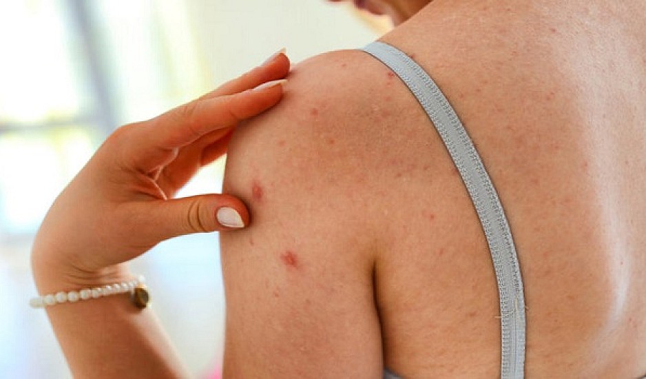 Καρκίνος του δέρματος: Τι σημαίνει φαγούρα σε ελιές