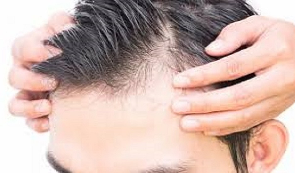 Έντονη τριχόπτωση: Πώς εξηγείται -  Ποιες είναι οι αιτίες που χάνετε μαλλιά