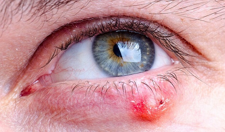 Κριθαράκι στο μάτι: Δείτε 4 φυσικές θεραπείες