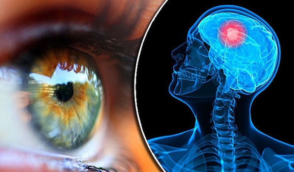 Το σημάδι στα μάτια που μπορεί να είναι πρώιμο σύμπτωμα για Αλτσχάιμερ