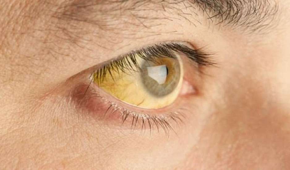 Κίτρινα μάτια: Τι προμηνύουν για την υγεία