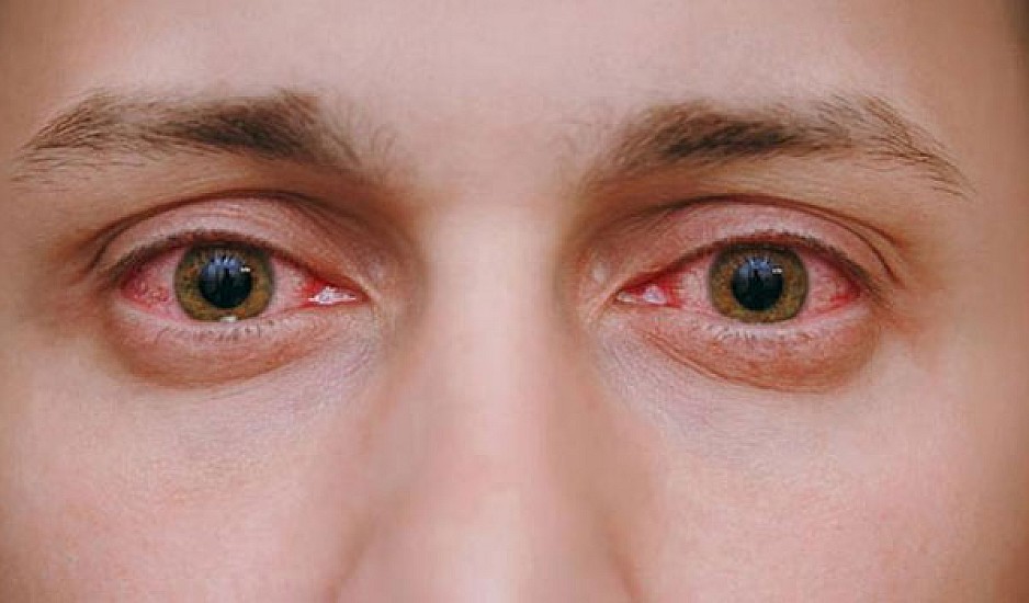 Κοκκίνισμα ματιών: 5 κοινές αιτίες και πώς θα το προλάβετε