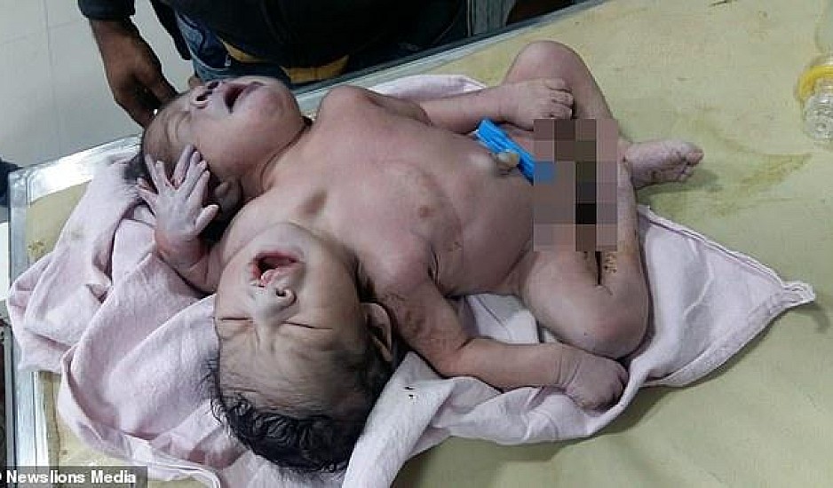 Μωρό γεννήθηκε με 2 κεφάλια και 3 χέρια. Σκληρές εικόνες