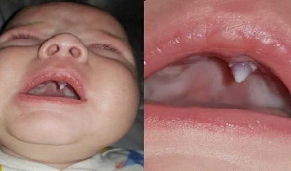 Νεογέννητο μωράκι έβγαλε δόντι βαμπίρ μέσα σε μια νύχτα