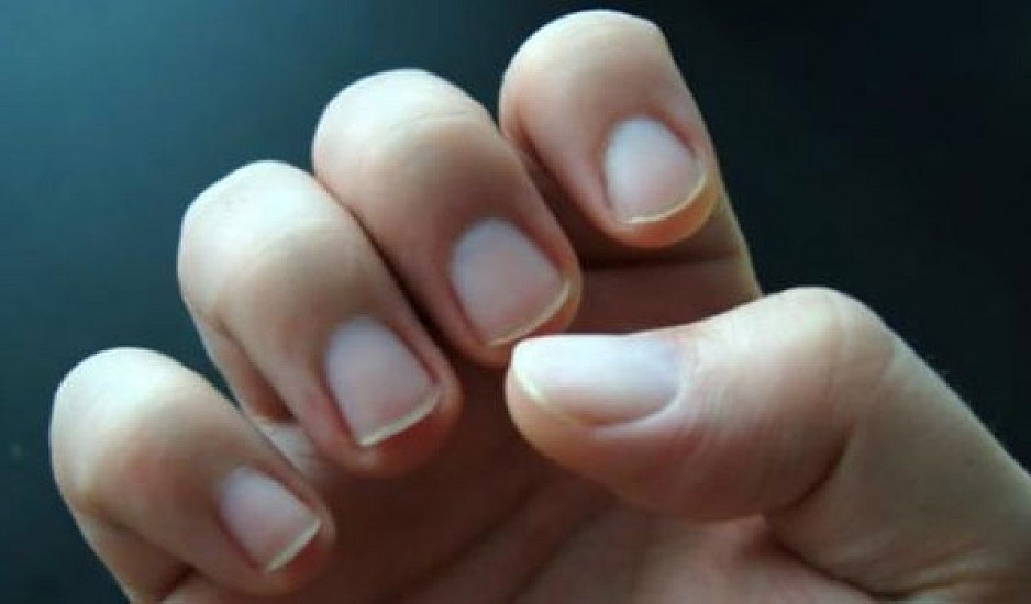 Είναι κίτρινα τα νύχια σας; Δείτε ποια νόσος μπορεί να "καραδοκεί"