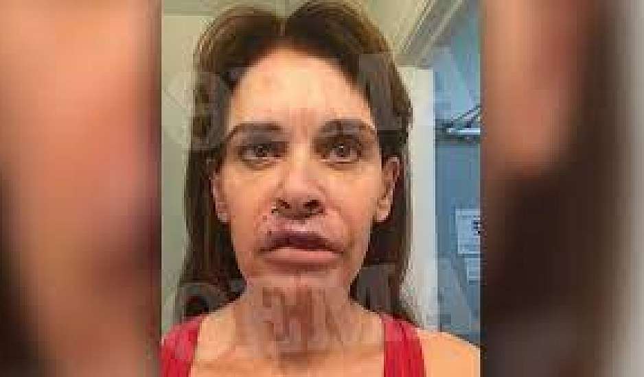 Πώς είναι σήμερα η Ελληνίδα συγγραφέας που είδε τα χείλη της να σαπίζουν μετά από πλαστική επέμβαση