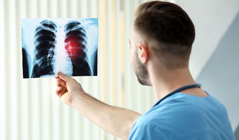 Καρκίνος πνεύμονα: Αυτό που αυξάνει τον κίνδυνο στους μη καπνιστές