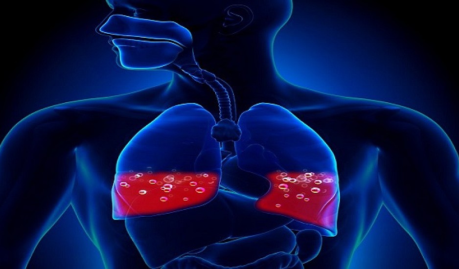 Πνευμονικό οίδημα: Τα συμπτώματα συσσώρευσης υγρού στους πνεύμονες