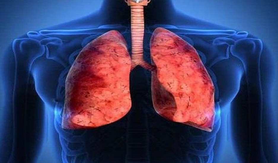 Εκστρατεία έγκαιρου ελέγχου για καρκίνο πνεύμονα χωρίς συμπτώματα
