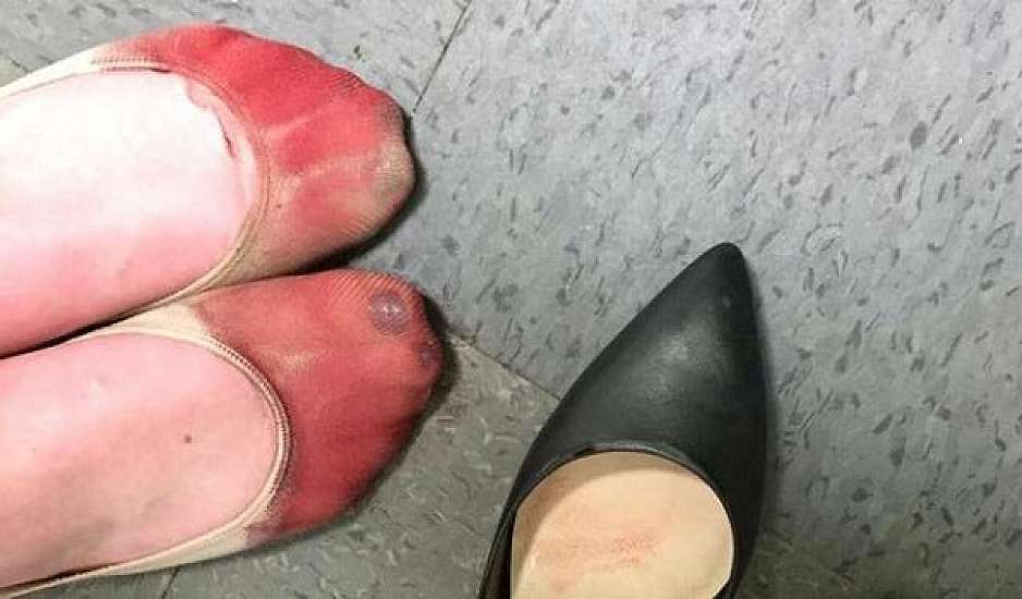 Τα καταματωμένα πόδια μιας σερβιτόρας από τα τακούνια στην πιο viral φωτογραφία