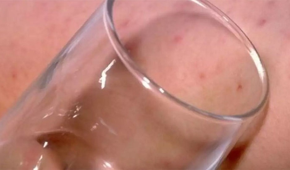 Το σημάδι στο δέρμα από μηνιγγίτιδα: Πώς γίνεται το τεστ με το ποτήρι
