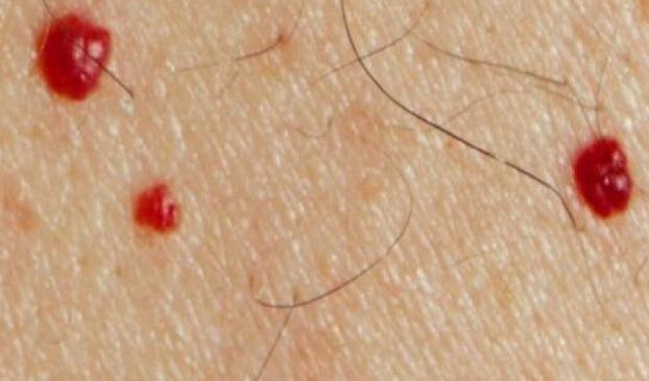 Κόκκινες ελιές στο δέρμα: Πότε βγαίνουν, ποιοι τύποι υπάρχουν και τι να προσέχετε
