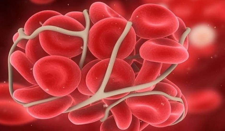 Ποια ομάδα αίματος κινδυνεύει περισσότερο από θρομβώσεις