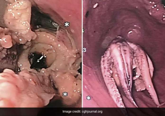 Πήγε στο νοσοκομείο με πρόβλημα κατάποσης και βρήκαν στον λαιμό του ένα χταπόδι - Εικόνες σοκ