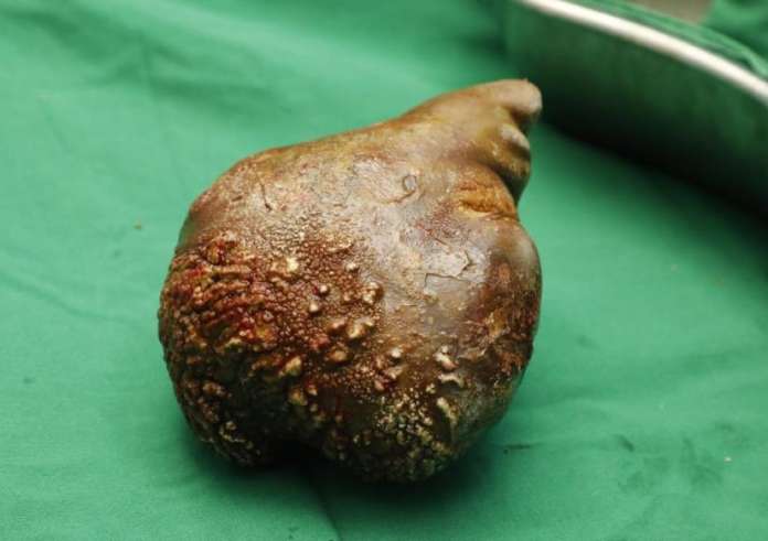 Αφαίρεσαν πέτρα από τα νεφρά βάρους 800 γραμμαρίων - Η μεγαλύτερη που έχει καταγραφεί ποτέ