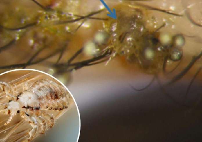 Ανατριχιαστικές εικόνες: Ψείρες έκαναν φωλιά στις βλεφαρίδες 3χρονου αγοριού