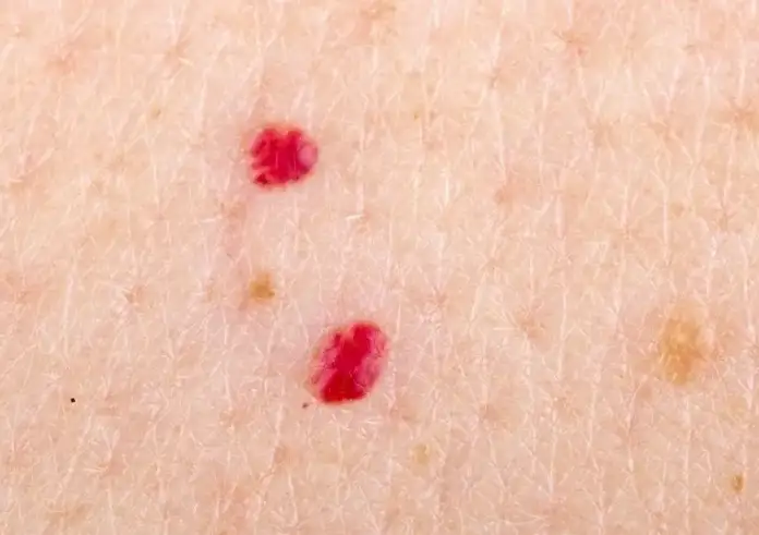 Κόκκινη ελιά στο δέρμα: Τι πρέπει να αποφεύγετε