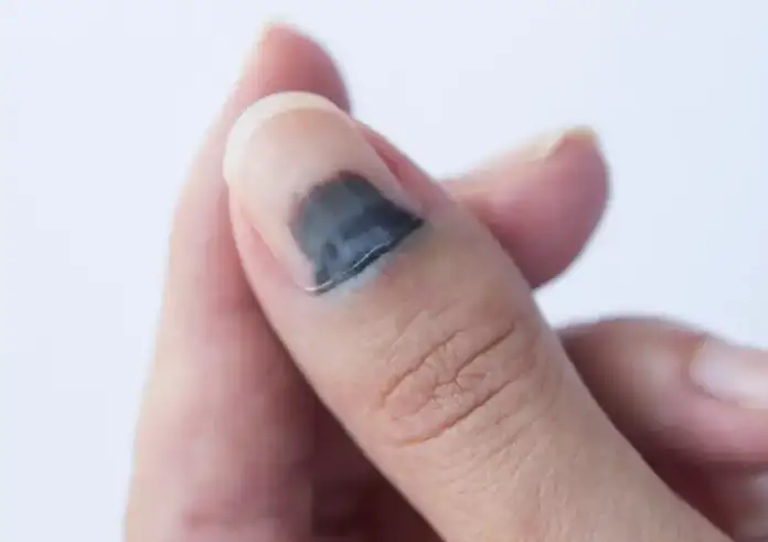 Μελανιά στο νύχι: Γιατί χρειάζεται άμεση ιατρική φροντίδα