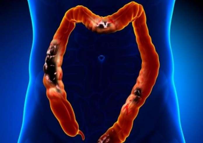 Νόσος του Crohn: Το Νο1 Σύμπτωμα της Χρόνιας Πάθησης του Εντέρου που Μπορεί να Εμφανιστεί στα Πόδια