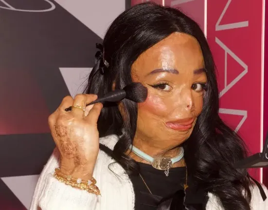 Τρόμος στο σπίτι: 12χρονη τυλίχθηκε στις φλόγες από σαμπουάν για ψείρες – Η συγκλονιστική μάχη της να «ξαναγεννηθεί»