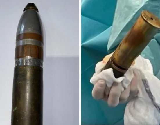 Συναγερμός σε νοσοκομείο: Πυροτεχνουργοί στα Επείγοντα για ενεργό βλήμα του 1918 σφηνωμένο σε ασθενή