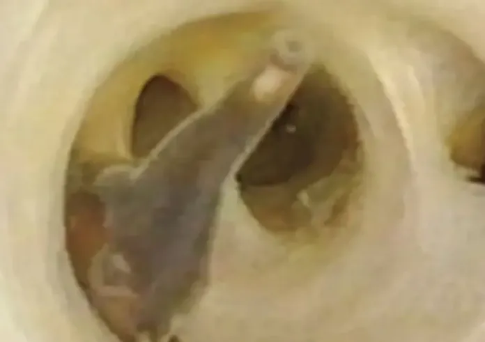 Αποκρουστικό βίντεο: Σκουλήκια στριφογυρίζουν στην κοιλιά 70χρονου