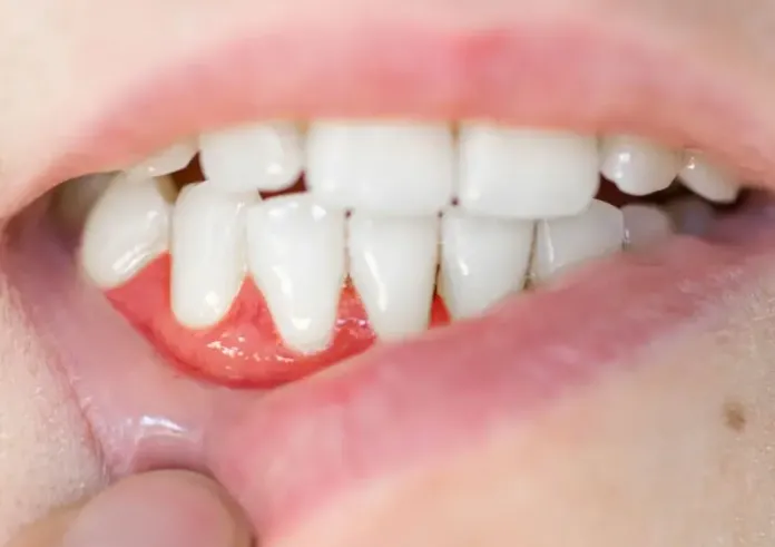Γιατί πρέπει να φροντίζετε τα δόντια σας αν θέλετε γερή καρδιά