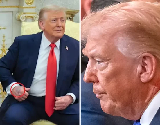 Ντόναλντ Τραμπ: Το «κόκκινο εξάνθημα» στον λαιμό και τα ερωτήματα για την υγεία του