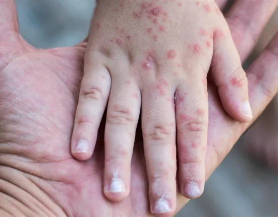 Συναγερμός από τον ΕΟΔΥ: Η ιλαρά συνεχίζει να προκαλεί σοβαρές επιπλοκές και θανάτους