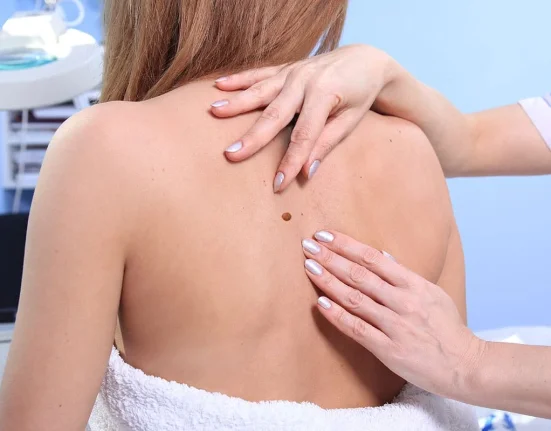 Καρκίνος του δέρματος: Ο «κανόνας ABCDE» για πρώιμη ανίχνευση και προστασία