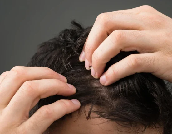 Πιτυρίδα ή ψωρίαση κεφαλιού: Πώς να τις διακρίνετε