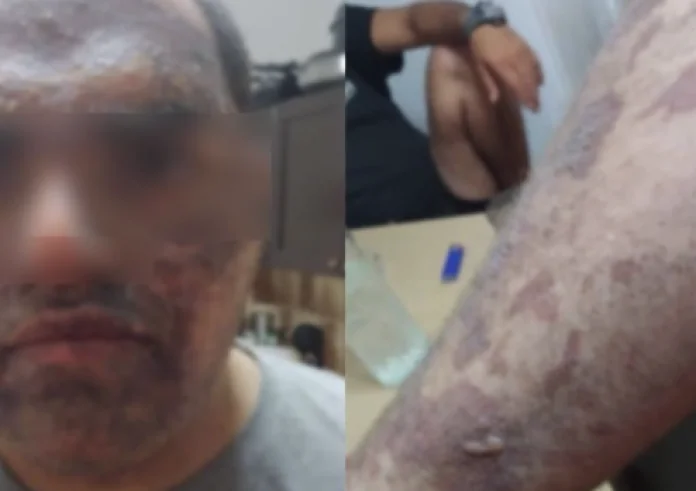 Κρήτη: Αδιαφορία καταγγέλλει η οικογένεια του 22χρονου εγκαυματία - Δεν έχει γίνει το παραμικρό