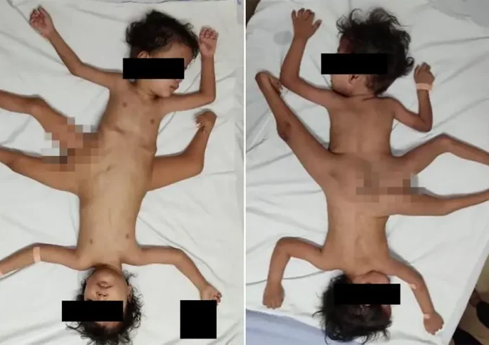 Σιαμαία έμειναν ξαπλωμένα τα τρία πρώτα χρόνια της ζωής τους