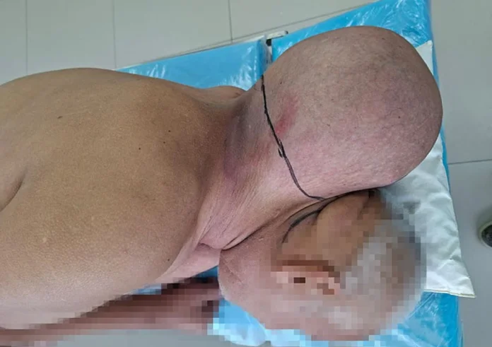 Τεράστιος όγκος αφαιρέθηκε από τον αυχένα 65χρονου μετά από 16 χρόνια
